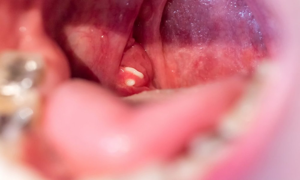 What Your ENT Wants You to Know About Tonsil Cryptolysis vs Tonsillectomy